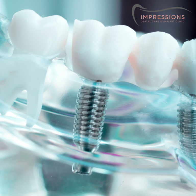Dental Implants and Oral Surgery Impressions Dental Care Nottingham